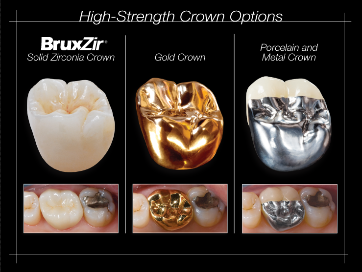 Should you get an all ceramic or gold crown? - JoyFulTeeth!
